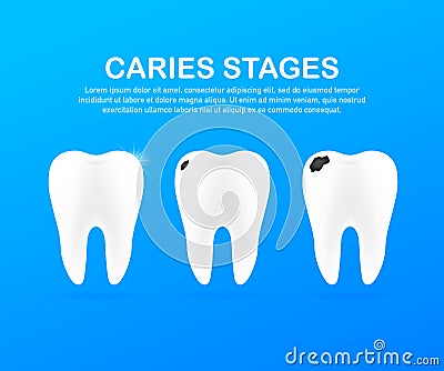 Stage of development of caries. Dental care concept. Healthy Teeth. Vector illustration. Vector Illustration